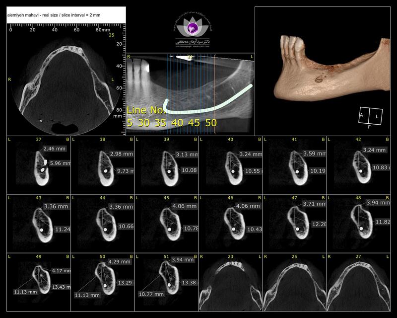 عکس CBCT دندان چیست؟ کاربرد و مزایا