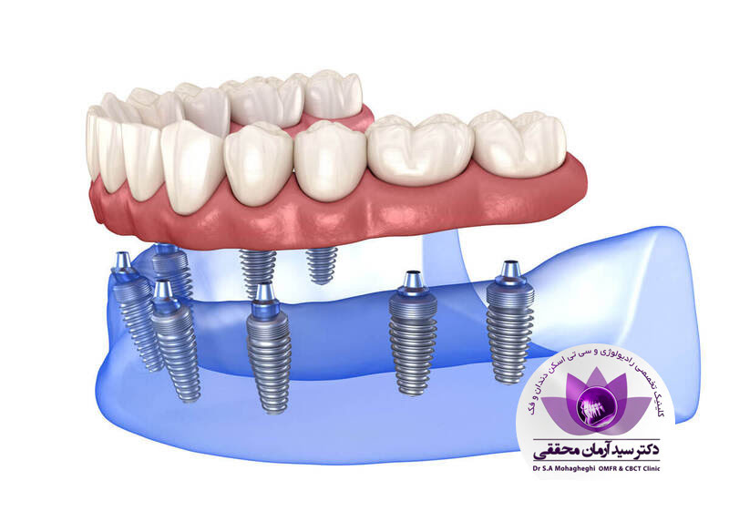 ایمپلنت دندان چیست؟