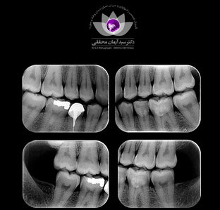 رادیوگرافی بایت وینگ چیست؟ | بررسی کاربرد آن در شهر اهواز