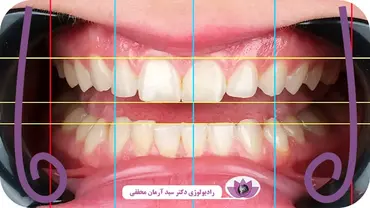 طراحی لبخند دیجیتال (DSD) چیست؟ | نوآوری در زیبایی دندانپزشکی